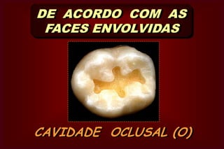  quando atinge duas faces do dente.CAVIDADE COMPOSTA