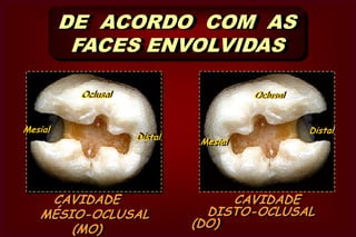  quando atinge três ou maisfacesdo dente.CAVIDADE COMPLEXA