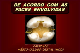 CAVIDADE  OCLUSAL (O)DE  ACORDO  COM  AS  FACES ENVOLVIDAS