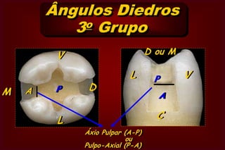 Ângulos Diedros      1o GrupoV- COuC- VL- COuC- LM- VOuV- ML- MOuM- LVestíbulo – Cervical  ouLinguo – Cervical ouMésio – Vestibular  ouLinguo – Mesial ouCérvico – LingualMésio – LingualCérvico – VestibularVestíbulo – MesialCavidade Mésio Oclusal (MO)MVLc