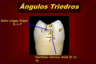 Ângulos Diedros      2o GrupoCavidade Oclusal (O)Vestíbulo-pulparV-Pou  Pulpo-VestibularDisto-pulpar  D-PouPulpo-DistalP-DVDPMMésio-pulpar  M-PouPulpo-MesialP-VLinguo-pulpar  L-PouPulpo-LingualL