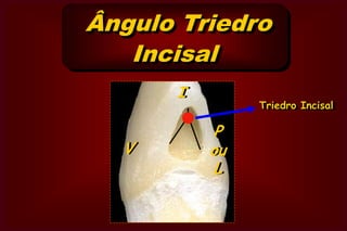 Ângulos Diedros      2o GrupoM ou DVLPACDisto-Pulpar (D-P) ou Pulpo-Distal (P-D)                                ouMésio-Pulpar (M-P) ou Pulpo-Mesial (P-M)Áxio Lingual (A-L)OuLíngüo-Axial (L-A)Áxio-Vestibular (A-V)ouVestíbulo-Axial (V-A)Áxio Cervical (A-C)ouCérvico-Axial (C-A)