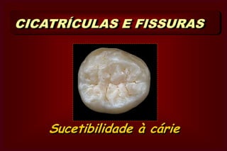 Ângulo Cavo-superficial É o  ângulo  formado pela    junção   das   paredes  da    cavidade com a superfície          externa do dente.