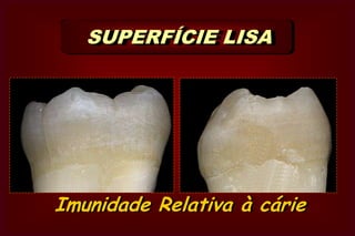 Ângulo Cavo-superficialCavo-superficial    Definido (Am)MONDELLI, 2003