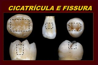  Baseada nas áreas do dente que apresentam suscetibilidade à cárie.