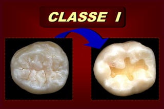 Cavidades em Cicatrículas e Fissuras