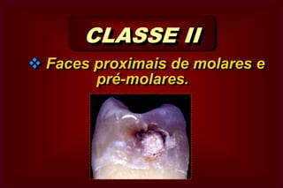 Cavidades em Superfície LisasCLASSIFICAÇÃO  DAS CAVIDADES PROPOSTA POR  G.V.BLACK Artificial  