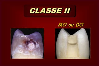  Baseada na técnica de instrumentação                        da cavidade