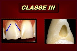 SUPERFÍCIE LISAImunidade Relativa à cárie