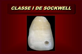 CLASSE II  Faces proximais de molares e                pré-molares.