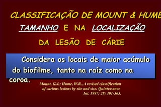  CLASSE V Terço  gengival  ou  cervical das  faces  vestibulares   e  linguais de todos  os dentes.CLASSE V