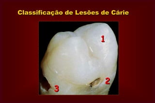 CLASSE VI  Bordas incisais e nas      pontas de cúspides.Howard e Simon