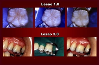 LOCALIZAÇÃO 1LOCALIZAÇÃO 2LOCALIZAÇÃO 3- Sulcos,  fissuras  e   defeitos  no  esmalte   da superfície oclusal dos dentes posteriores ou de outras superfícies lisas.- Superfície proximal imediatamente abaixo das áreas de contato com o dente vizinho. - Superfície  correspondente ao 1/3 gengival daCoroa ou superfície radicular.