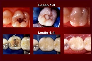 TAMANHO 3TAMANHO 4 A cavidade é maior que a anterior, no  entanto, o remanescente dental é suficientemente forte para                         suportar a restauração. Cáries extensas com grande perda de estrutura          dentária ou ausência total de cúspides.