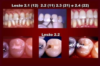 TamanhoMínimoModeradaAmplaExtensaLocalização(1)               (2)             (3)       (4)Cicatrículas e Fissuras (1)1.11.2 1.31.4Faces de Contato  (2)                  2.1                  2.2 2.3        2.4Cervical (3)                                  3.1               3.2           3.3      3.4 Proposta de Classificação    de Lesões de Cárie MOUNT, G.J. & HUME, W.R. Quintessense Int. 28 : 301-3,1997