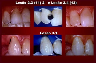 Não inclusão de lesões cariosas não cavitadas;