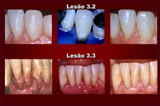  Não referências à profundidade da lesão.DEFICIÊNCIAS NESTA CLASSIFICAÇÃOClassificação MOUNT & HUME MODIFICADALASFARGUES,J.J. et al. – New concepts of minimally invasive preparations: a SI/STAconcept. In: ROULET,J.F. & DEGRANGE,M. ADHESION: the silent revolution. Quintessense, London, 2000, 107- 152
