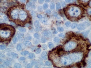 CD15 demonstrating Reed-Sternberg Cells in Hodgkin's Lymphoma