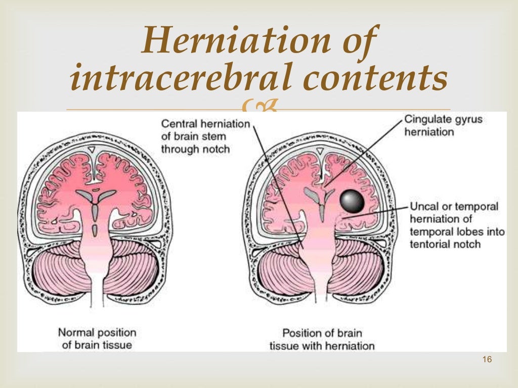 Increased intracranial pressure