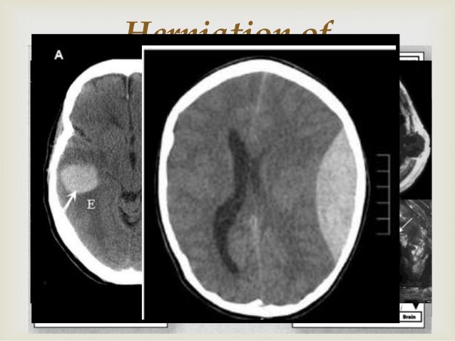 Increased intracranial pressure