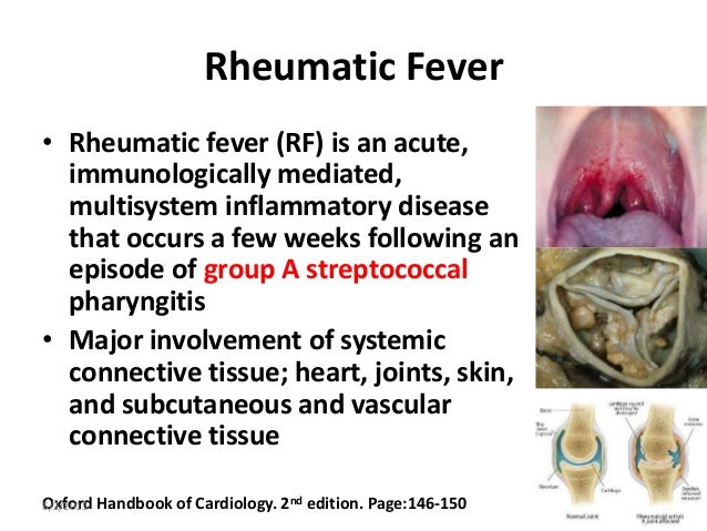 Rheumatic Fever • Rheumatic fever (RF) is an acute, immunologically mediated, multisystem inflammatory disease that occurs...