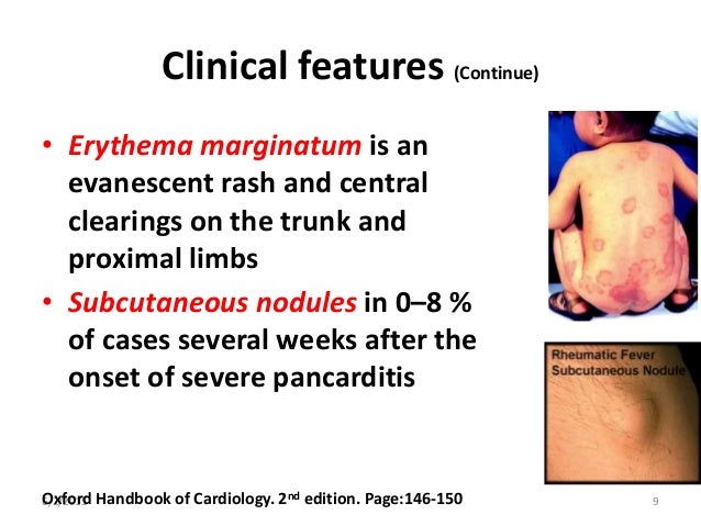 Clinical features (Continue) • Erythema marginatum is an evanescent rash and central clearings on the trunk and proximal l...