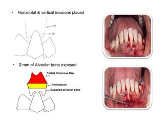 case report of Periosteal pedicle graft-novel technique | PPT