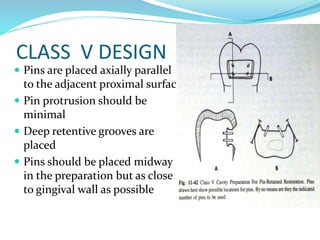 CLASS V DESIGN
 Pins are placed axially parallel
to the adjacent proximal surface
 Pin protrusion should be
minimal
 Deep retentive grooves are
placed
 Pins should be placed midway
in the preparation but as close
to gingival wall as possible
 