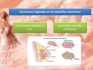 Carcinoma originado en los lobulillos mamarios:

Carcinoma lobulillar in
situ.

Carcinoma lobulillar
infiltrante.

 