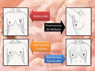 Rubicundez
Prominencia
de Nódulos

Alteraciones
Cutáneas
Red Venosa
Acentuada

 