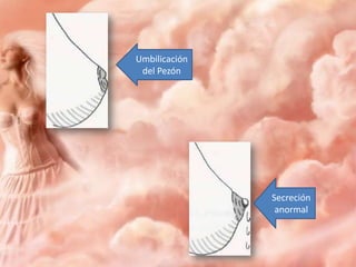 Umbilicación
del Pezón

Secreción
anormal

 