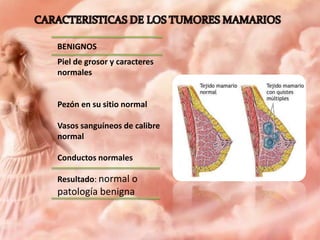 BENIGNOS
Piel de grosor y caracteres
normales

Pezón en su sitio normal
Vasos sanguíneos de calibre
normal
Conductos normales
Resultado: normal o

patología benigna

 