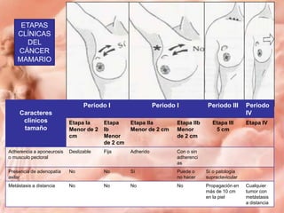 ETAPAS
CLÍNICAS
DEL
CÁNCER
MAMARIO

Periodo I
Caracteres
clínicos
tamaño

Periodo I

Periodo III

Periodo
IV

Etapa III
5 cm

Etapa IV

Etapa Ia
Menor de 2
cm

Etapa
Ib
Menor
de 2 cm

Etapa IIa
Menor de 2 cm

Etapa IIb
Menor
de 2 cm

Adherencia a aponeurosis
o musculo pectoral

Deslizable

Fija

Adherido

Con o sin
adherenci
as

Presencia de adenopatía
axilar

No

No

Sí

Puede o
no hacer

Sí o patología
supraclavicular

Metástasis a distancia

No

No

No

No

Propagación en
más de 10 cm
en la piel

Cualquier
tumor con
metástasis
a distancia

 