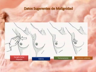 Ganglio Axilar
Palpable

Edema

Tumoraciones

Lesiones cutáneas

 