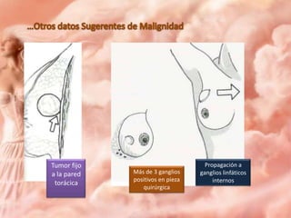 Tumor fijo
a la pared
torácica

Más de 3 ganglios
positivos en pieza
quirúrgica

Propagación a
ganglios linfáticos
internos

 