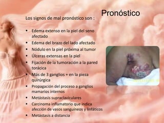 Los signos de mal pronóstico son :

Pronóstico

 Edema extenso en la piel del seno
afectado
 Edema del brazo del lado afectado
 Nódulo en la piel próxima al tumor
 Úlceras extensas en la piel
 Fijación de la tumoración a la pared
torácica
 Más de 3 ganglios + en la pieza
quirúrgica
 Propagación del proceso a ganglios
mamarios internos
 Metástasis supraclaviculares
 Carcinoma inflamatorio que indica
afección de vasos sanguíneos y linfáticos
 Metástasis a distancia

 