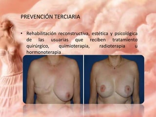 PREVENCIÓN TERCIARIA
• Rehabilitación reconstructiva, estética y psicológica
de las usuarias que reciben tratamiento
quirúrgico,
quimioterapia,
radioterapia
u
hormonoterapia

 