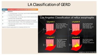 GERD -Gastro esophageal reflux disease | PPTX