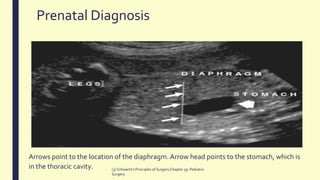 Prenatal Diagnosis
Arrows point to the location of the diaphragm. Arrow head points to the stomach, which is
in the thoracic cavity. (3) Schwartz's Principles of SurgeryChapter 39: Pediatric
Surgery
 