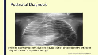 Postnatal Diagnosis
(2)Jones Clinical PediatricSurgery 7th Edition
congenital diaphragmatic hernia (Bochdalek type). Multiple bowel loops fill the left pleural
cavity, and the heart is displaced to the right.
 