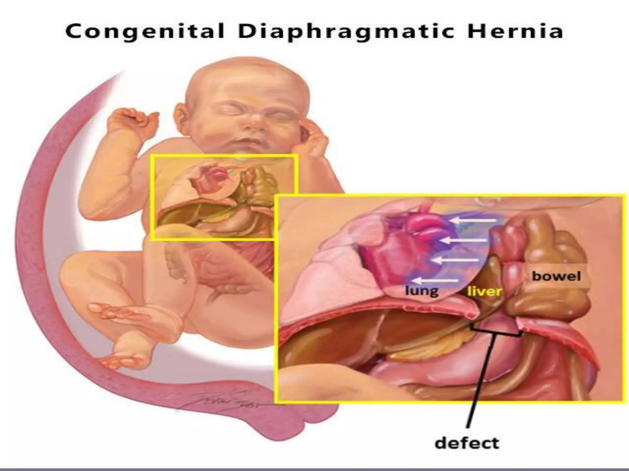 Congenital diaphragmatic hernia (CDH) | PPT