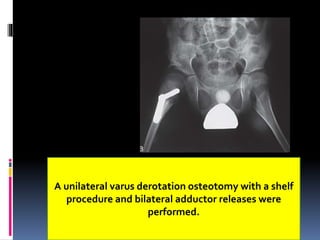 A unilateral varus derotation osteotomy with a shelf
procedure and bilateral adductor releases were
performed.
 