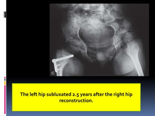 The left hip subluxated 2.5 years after the right hip
reconstruction.
 