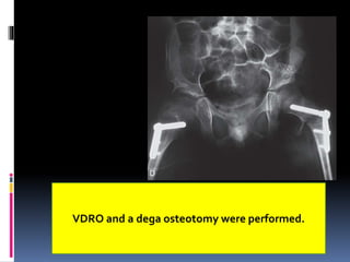 VDRO and a dega osteotomy were performed.
 