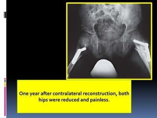 One year after contralateral reconstruction, both
hips were reduced and painless.
 