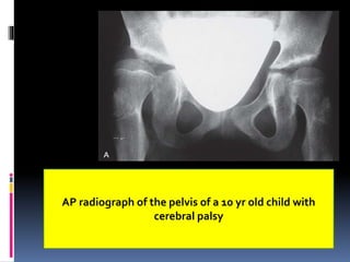AP radiograph of the pelvis of a 10 yr old child with
cerebral palsy
 