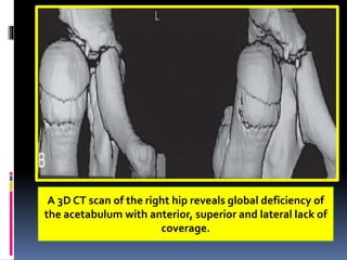 A 3D CT scan of the right hip reveals global deficiency of
the acetabulum with anterior, superior and lateral lack of
coverage.
 