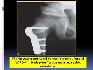 The hip was reconstructed by muscle release , femoral
VDRO with blade plate fixation and a dega pelvic
osteotomy.
 