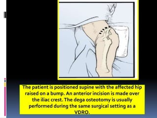 The patient is positioned supine with the affected hip
raised on a bump. An anterior incision is made over
the iliac crest.The dega osteotomy is usually
performed during the same surgical setting as a
VDRO.
 