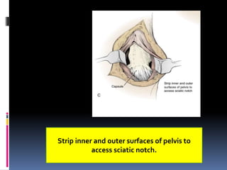 Strip inner and outer surfaces of pelvis to
access sciatic notch.
 
